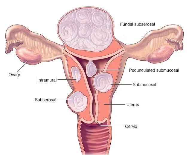 ds00078_-my00501_im01586_hdg7_fibroidlocationthu_jpg-1