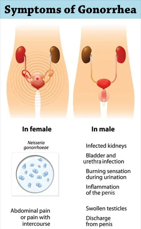 symptomss-of-gonorrhea-1