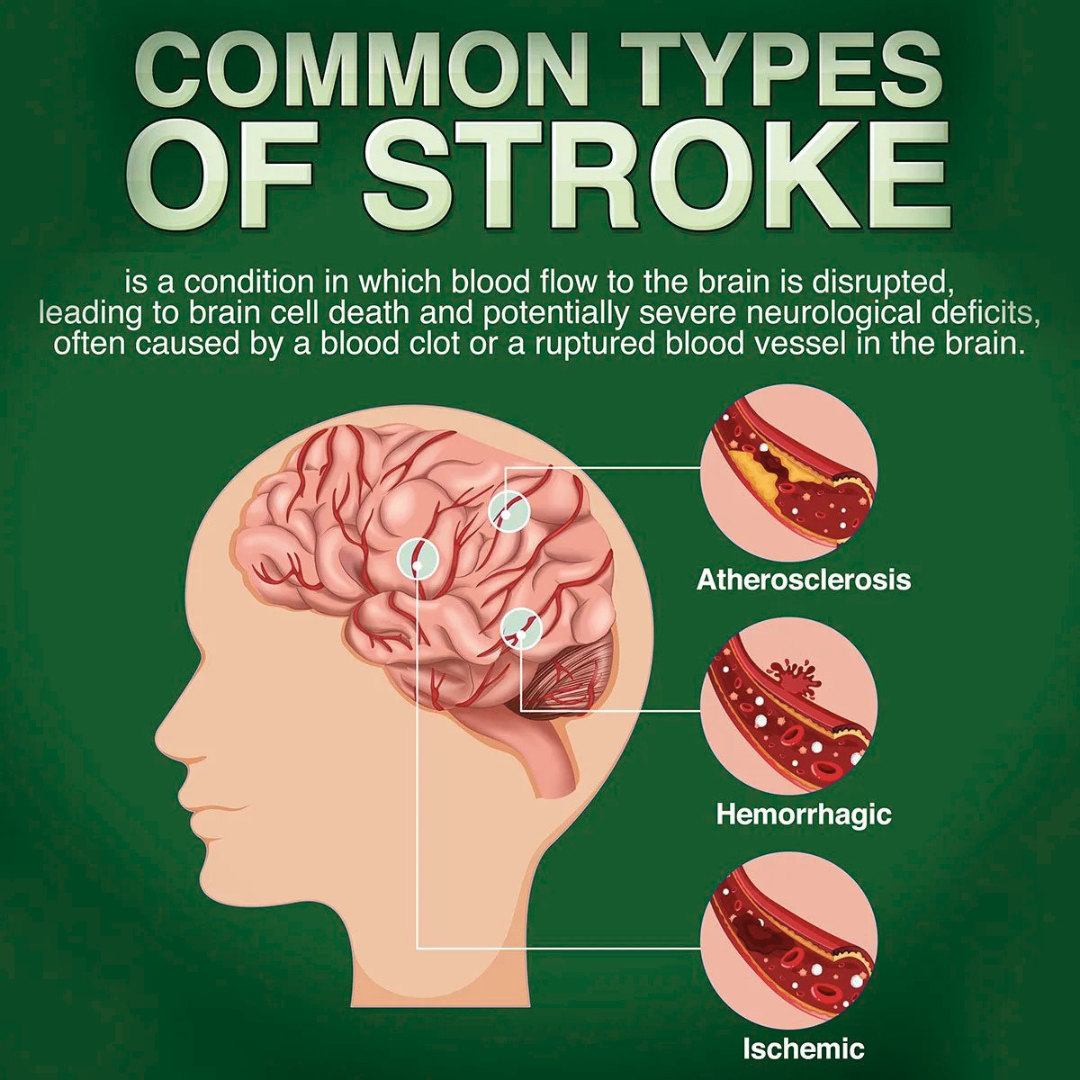 Stroke Attack Is Dangedrous